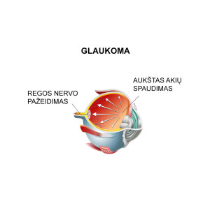 Glaukomos požymiai